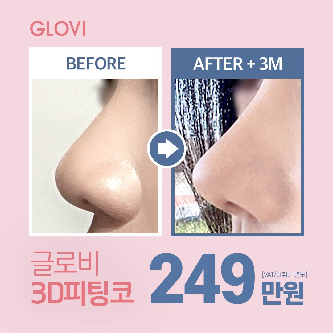 GLOVI BEFORE AFTER + 3M 글로비 3D피팅코 249 만원 [VAT/마취비 별도]