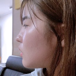 #코재수술 BEFORE