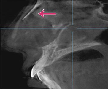 수술 후 CT 옆모습 영상 — 분홍 화살표로 보형물 위치 표시