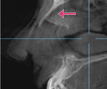 수술 후 CT 확대 영상 — 분홍 화살표로 보형물 밀착 표시