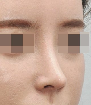 코 수술 후 사진
