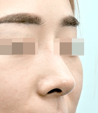 코 수술 후 사진