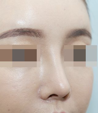 코 수술 후 사진