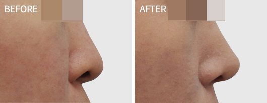 코 옆모습 BEFORE / AFTER