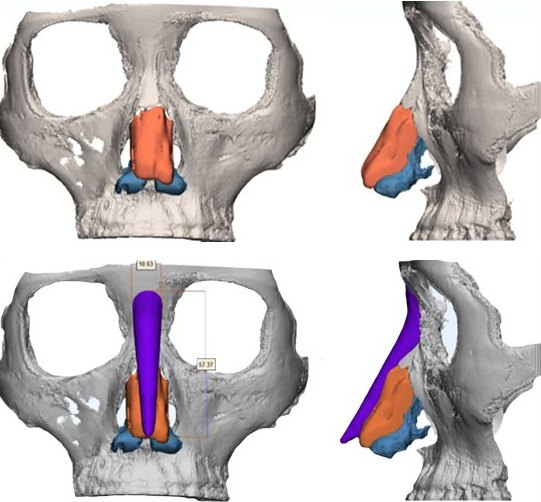 3D CT 두개골 앞·옆 모습 2단 — 위: 연골, 아래: 보라색 보형물 배치·치수 표시