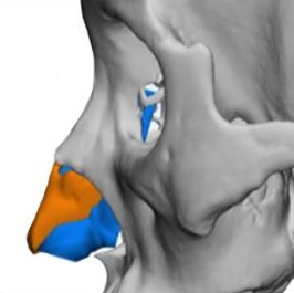 3D CT 코뼈 모델 옆모습